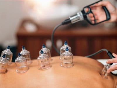 Hijama with Cupping Hijama with Cupping